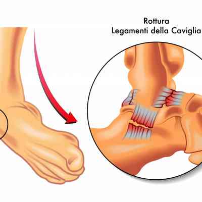 ankle-sprains-chronic-instability1.jpg